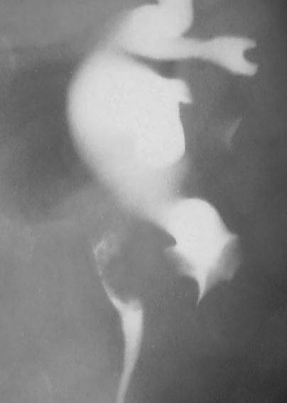 Transitional Cell Prox Ureter